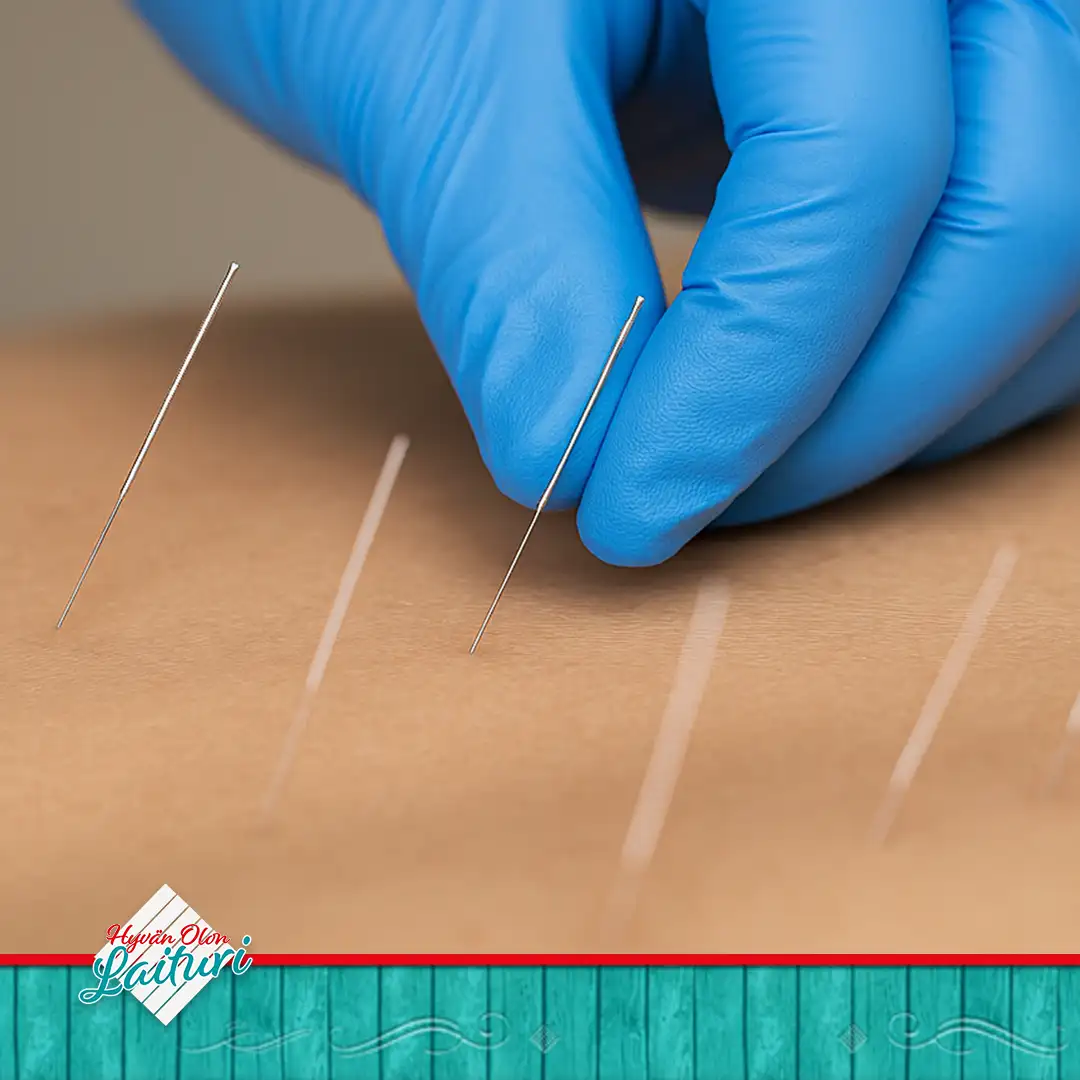 Dry Needling Content Pic - Hyvän Olon Laituri tarjoaa laajan valikoiman hyvinvointipalveluja Kuopiossa.